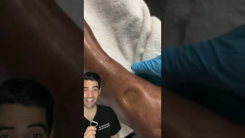 Water in the Leg