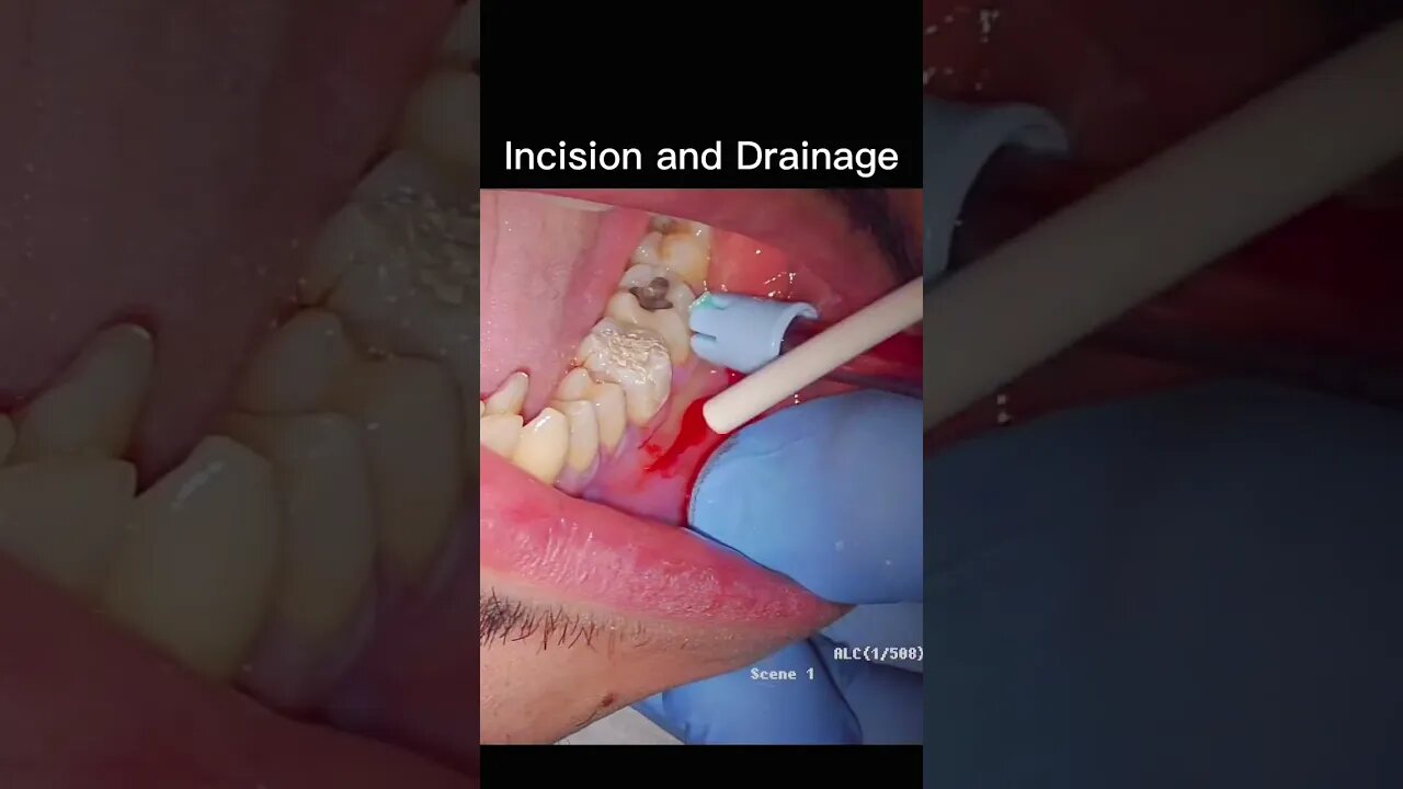 Incision and Drainage Abscess Draining Pus