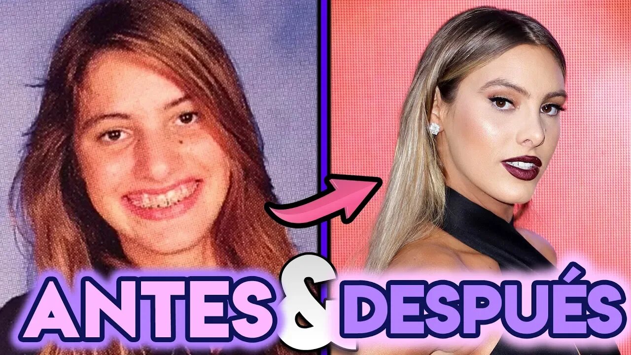 Lele Pons | Transformación Antes y Después | Cirugías Estéticas