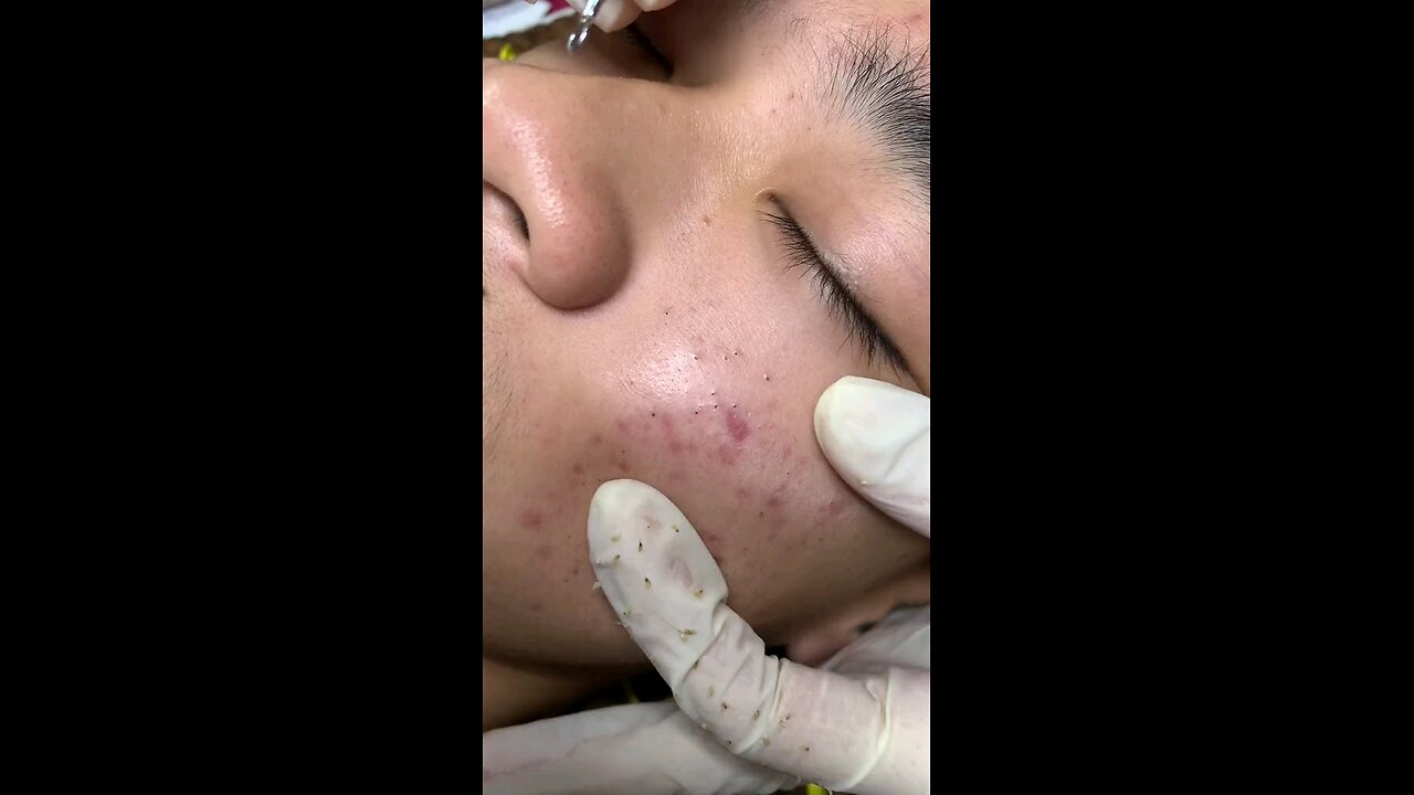 Blackheads episode 14