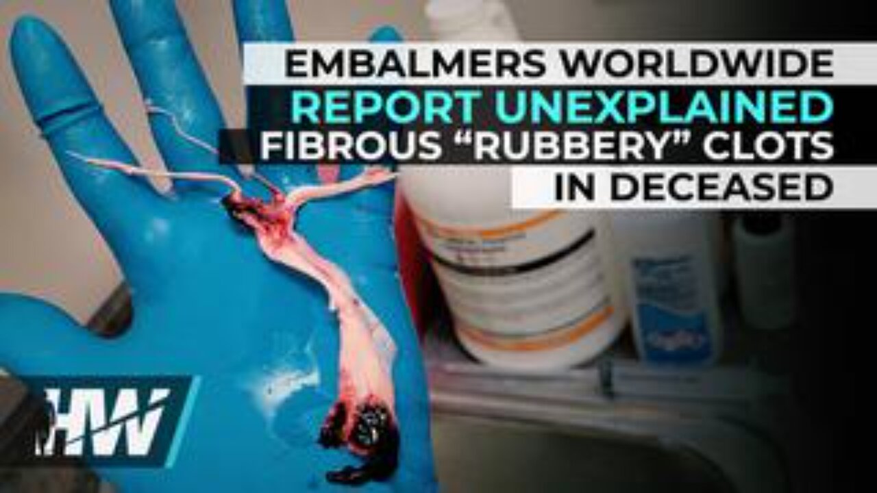 Embalmers Worldwide Report Unexplained Fibrous “Rubbery” Clots in Deceased