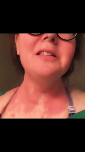 Johnson & Johnson "vaccine" causes horrible skin reaction... but she´s thankful 🤦