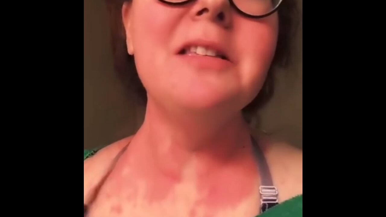 Johnson & Johnson "vaccine" causes horrible skin reaction... but she´s thankful 🤦