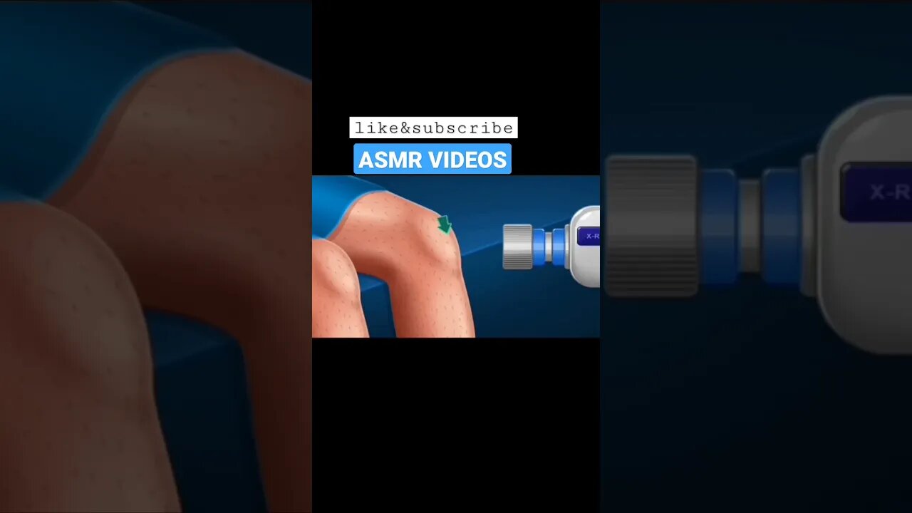 ASMR || Ankle Knee || Fracture treatment|| #shorts