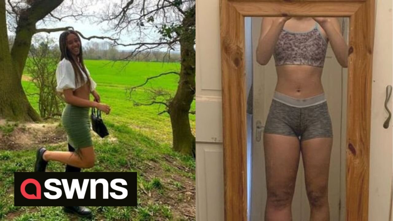 Meet the woman whose left leg is more than double the size of her right one due to a rare condition