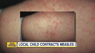Unvaccinated child contracts measles in Pinellas County