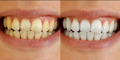 With only one Application it eliminates all TARTARO of the Teeth and Whitening