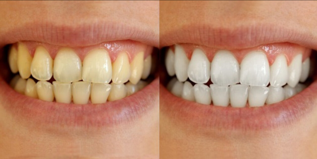 With only one Application it eliminates all TARTARO of the Teeth and Whitening