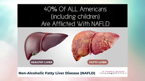 Fatty Liver: The Silent Killer