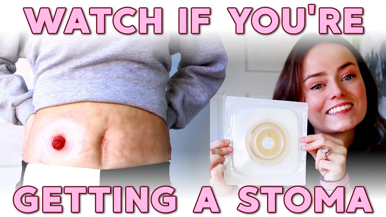 Watch If You're Getting a Stoma! | Let's Talk IBD