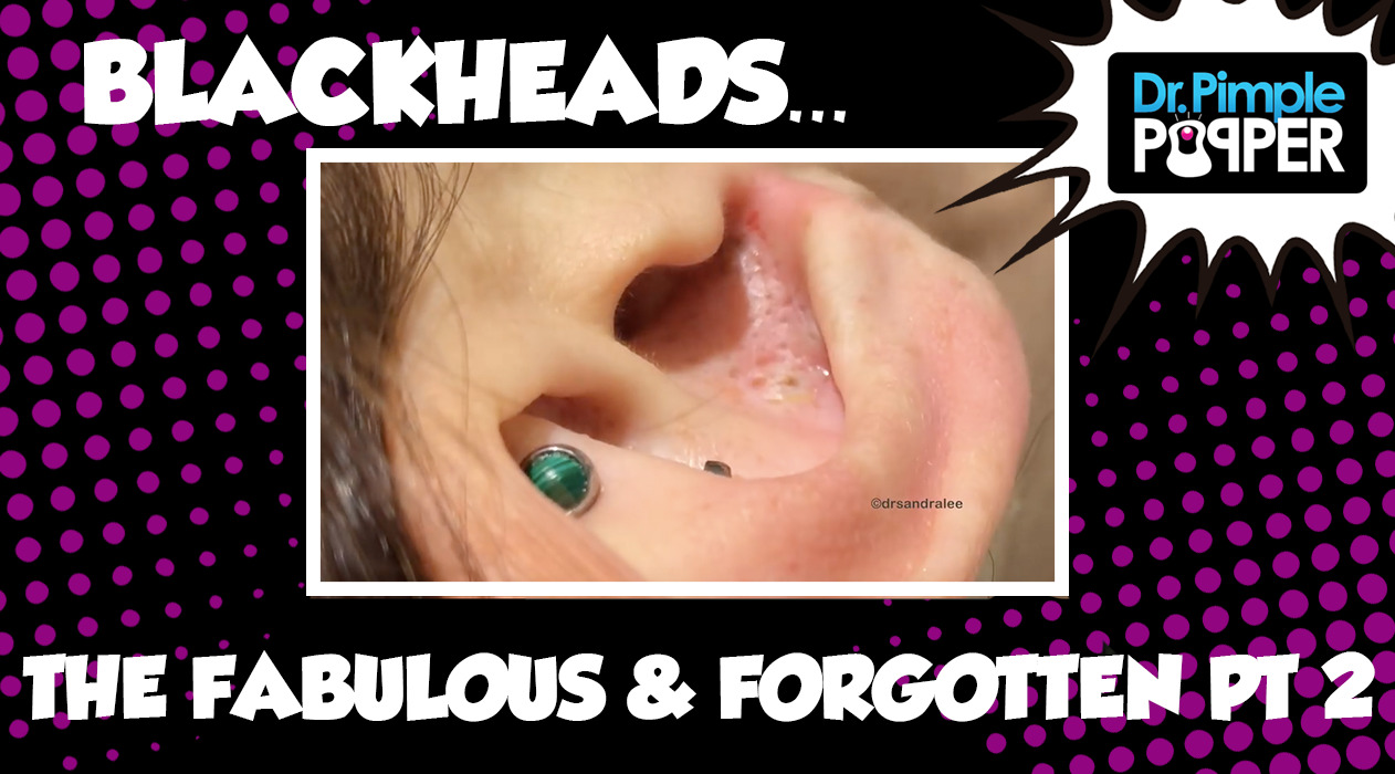 Blackheads: The Fabulous & Forgotten, Part Two