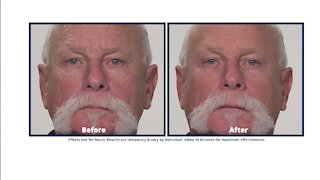 Try Plexaderm and get rid of undereye bags, just in time for Thanksgiving!
