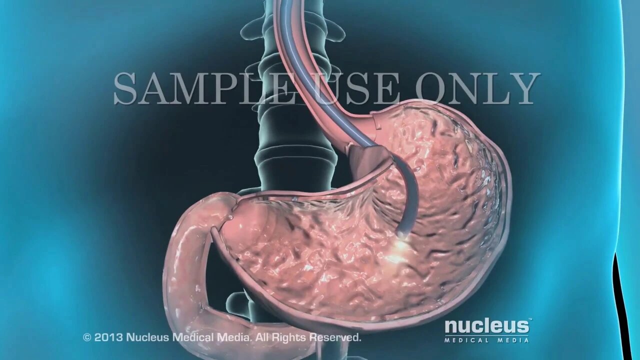 Endoscopia del tracto gastrointestinal superior