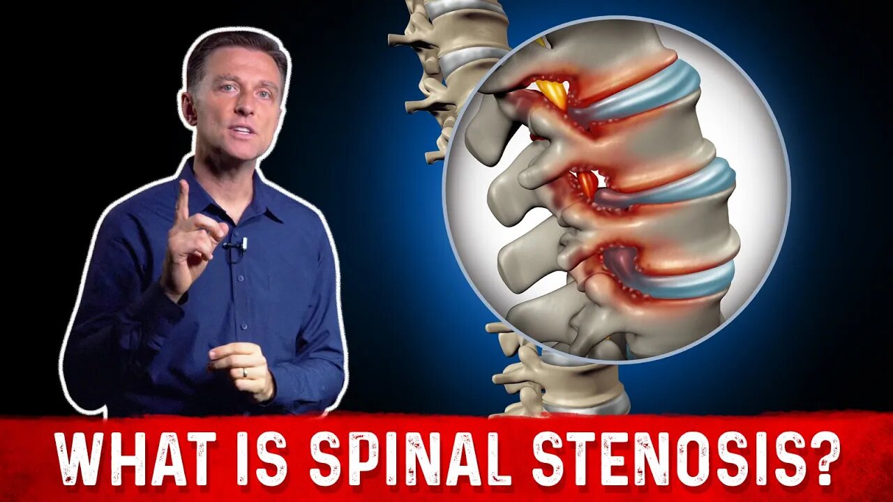 What is Spinal Stenosis And It's Causes Explained By Dr. Berg