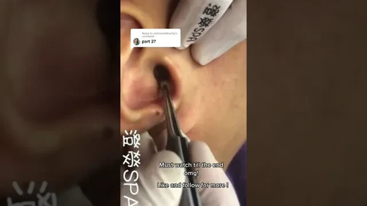 Must watch till the end ! Ear Blackhead Removal