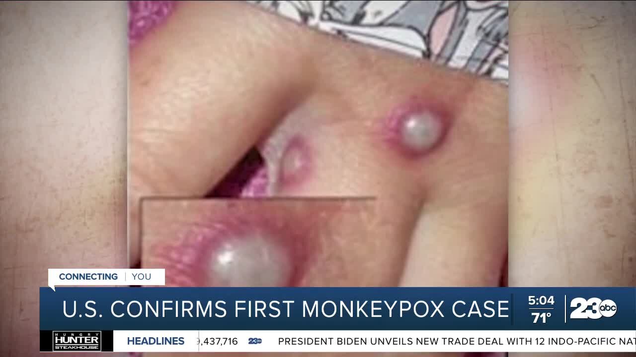 U.S. confirms monkeypox case