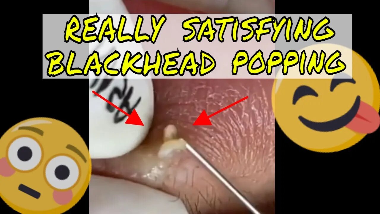 Really satisfying blackhead popping around the lips 😅🪱 #blackheadremoval #blackhead #blackheads