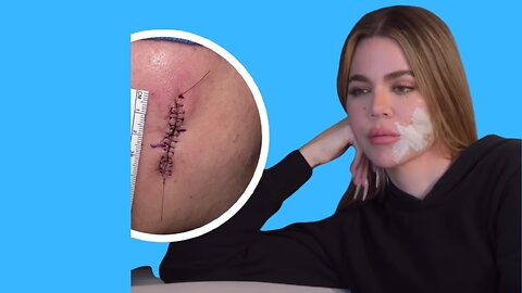 Khloe Kardashian Being Open About Her Skin Cancer