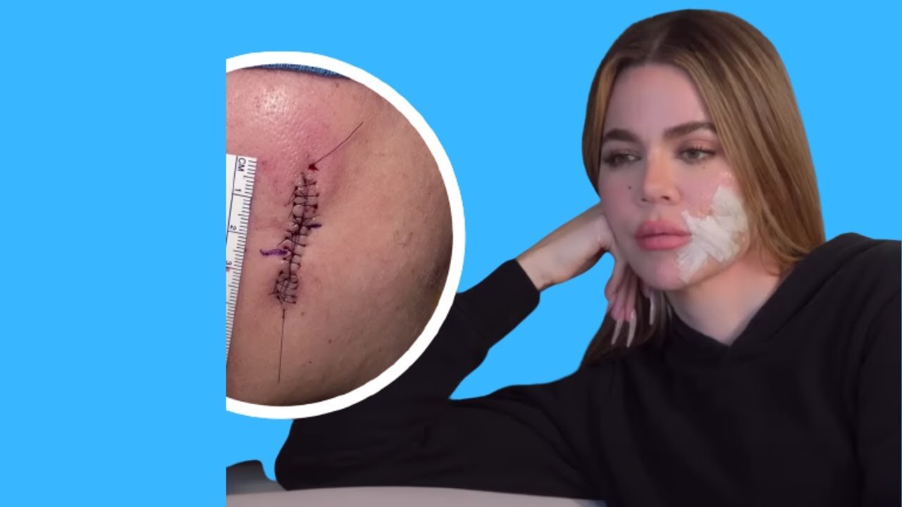Khloe Kardashian Being Open About Her Skin Cancer