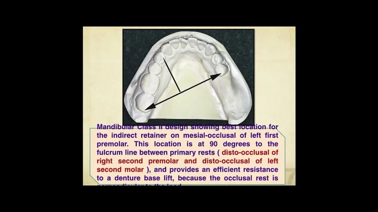 Prosthodontics L14 (Indirect Retainers)