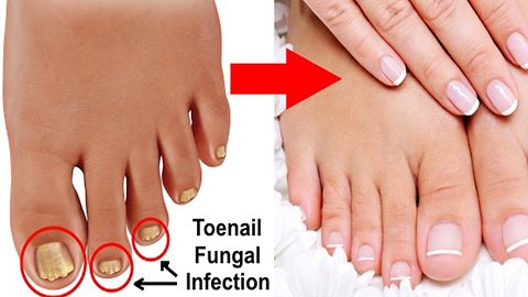 3 Simple and Effective Natural Cures for Toenail Fungus