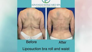 High Def Lipo at Advanced Image Med Spa can help you get ready for swimsuit season