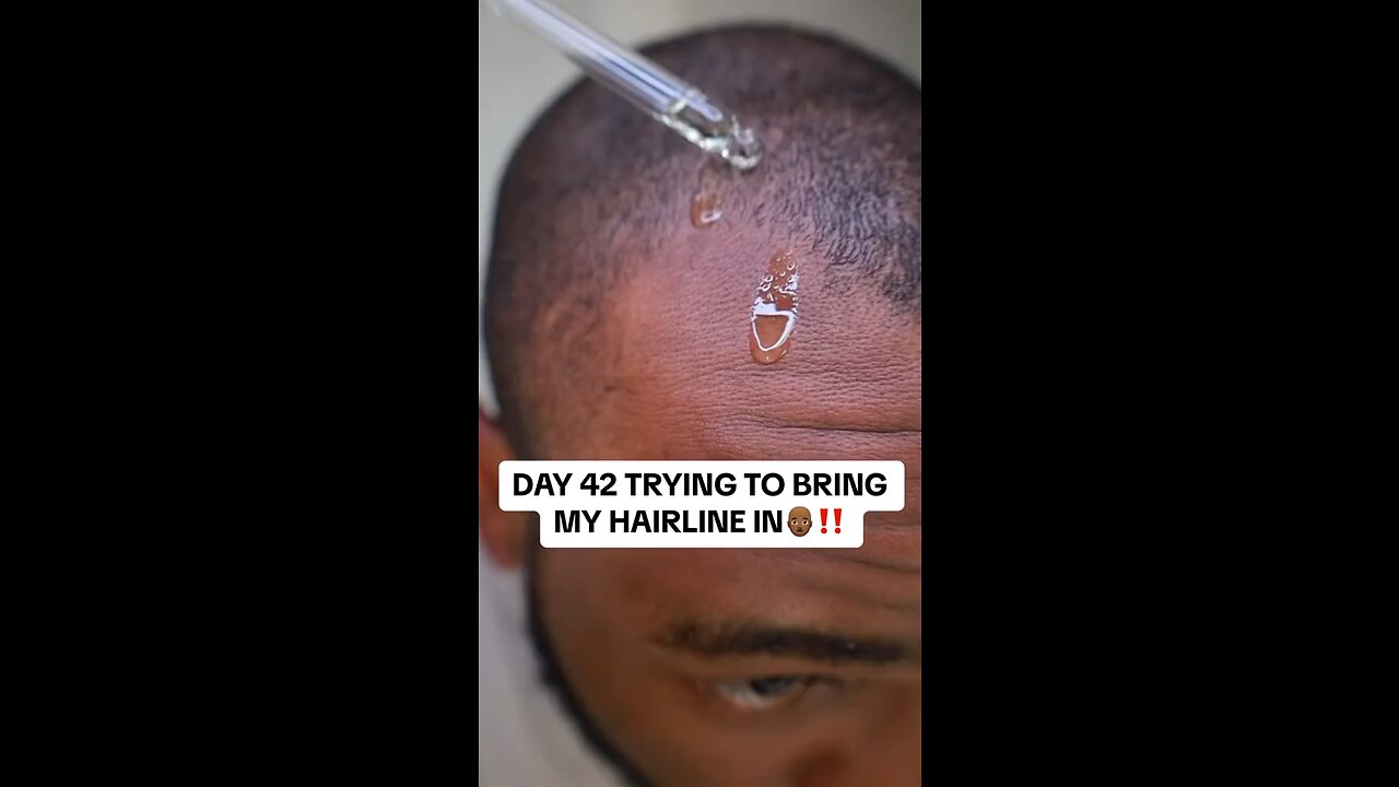 DAY 42 TRYING TO BRING MY HAIRLINE IN👨🏾‍🦲‼️