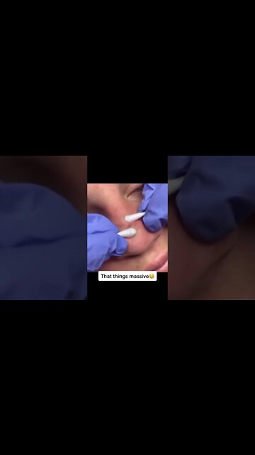 Blackhead removal on Nose 👃