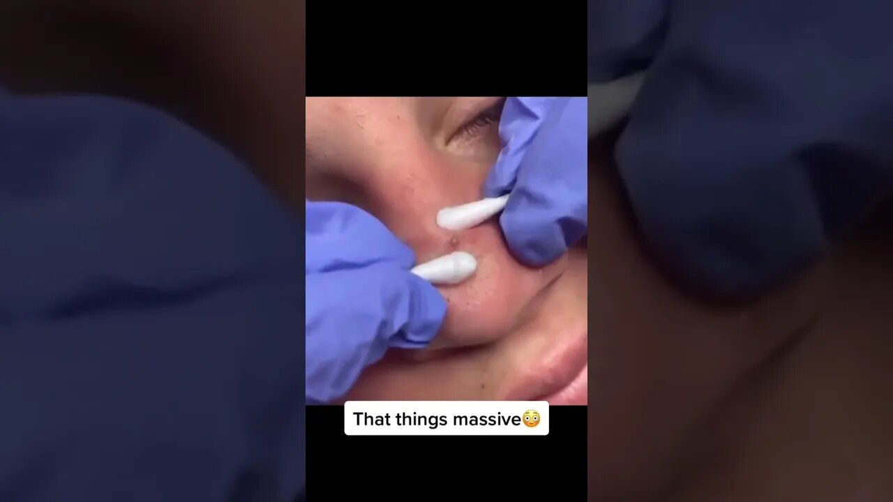 Blackhead removal on Nose 👃
