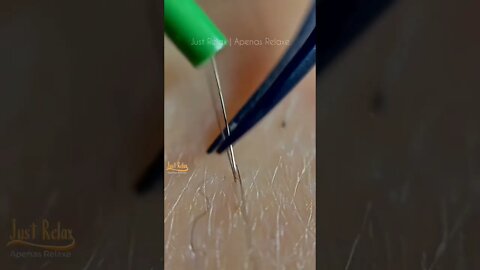 Vídeo Satisfatório Eletrólise Depilação Elétrica Definitiva - Relaxing and Satisfying Electrolysis