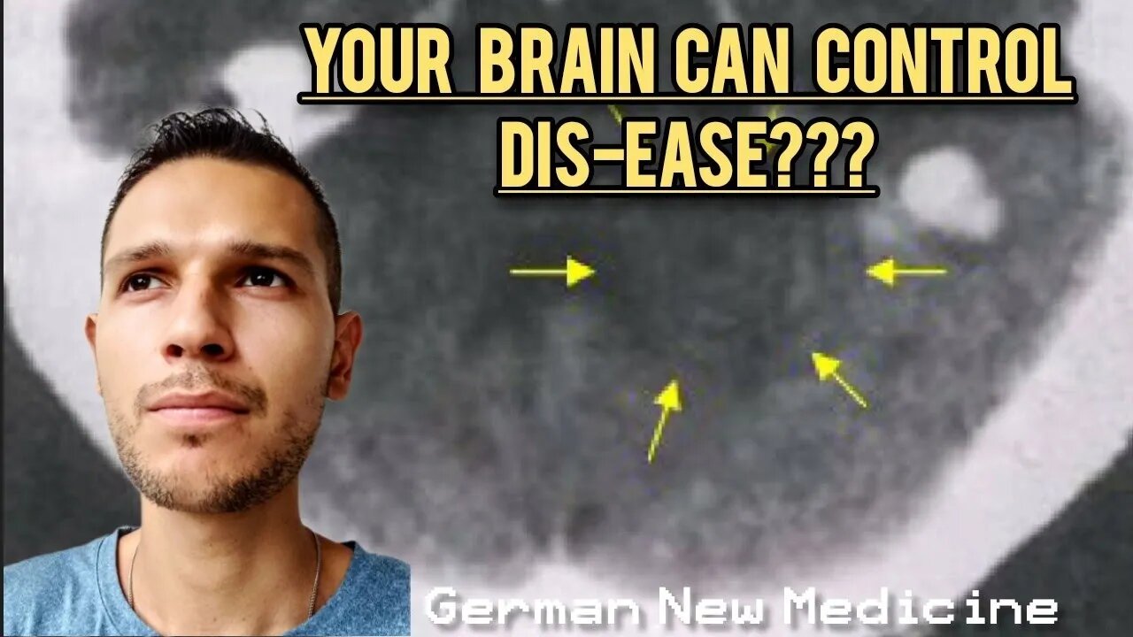 Your Brain Controls Dis-ease?!German New Medicine (Dr. Hamer)