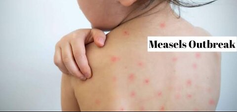 Measles Outbreak Increasing worldwide