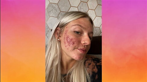 My Cystic Acne Is So Bad It Went Viral | SHAKE MY BEAUTY