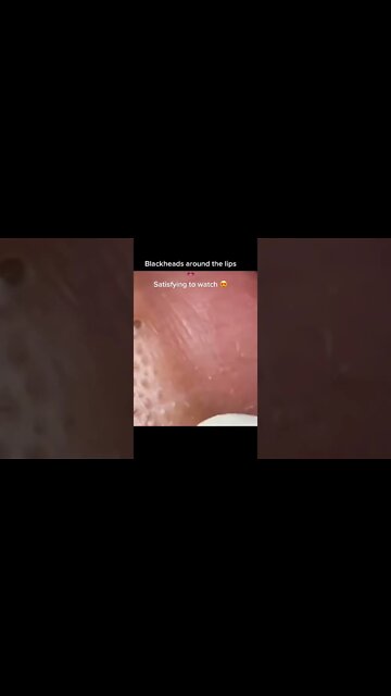 Blackheads around the Lips Removal 💋