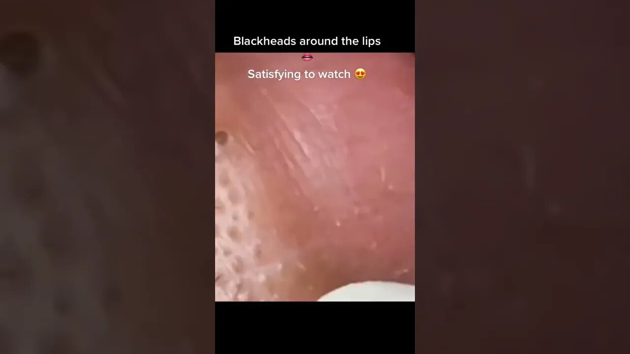 Blackheads around the Lips Removal 💋