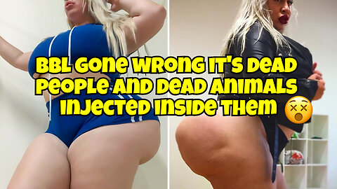 WOMEN WHO ARE GETTING BBL ARE BEING INJECTED WITH DEAD PEOPLE AND ANIMAL'S CELLS