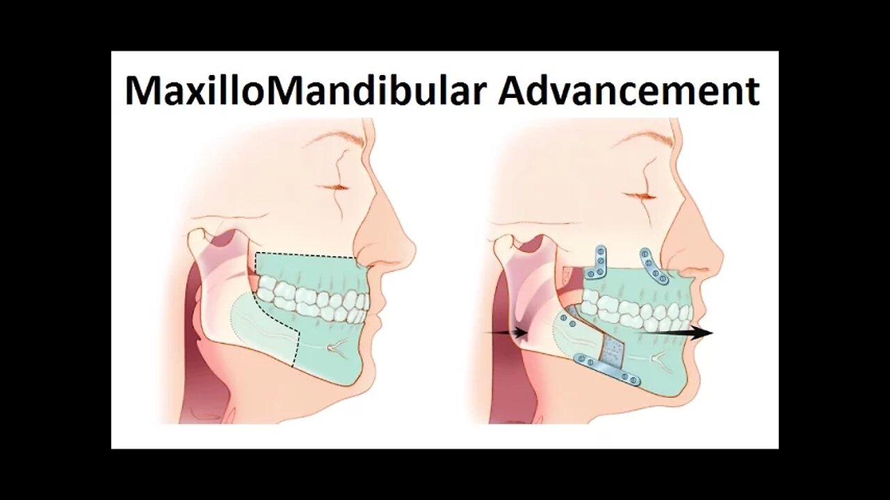 Surgical Treatment of Retruded Jaws (MaxilloMandibular Advancement Surgery) by Dr Mike Mew