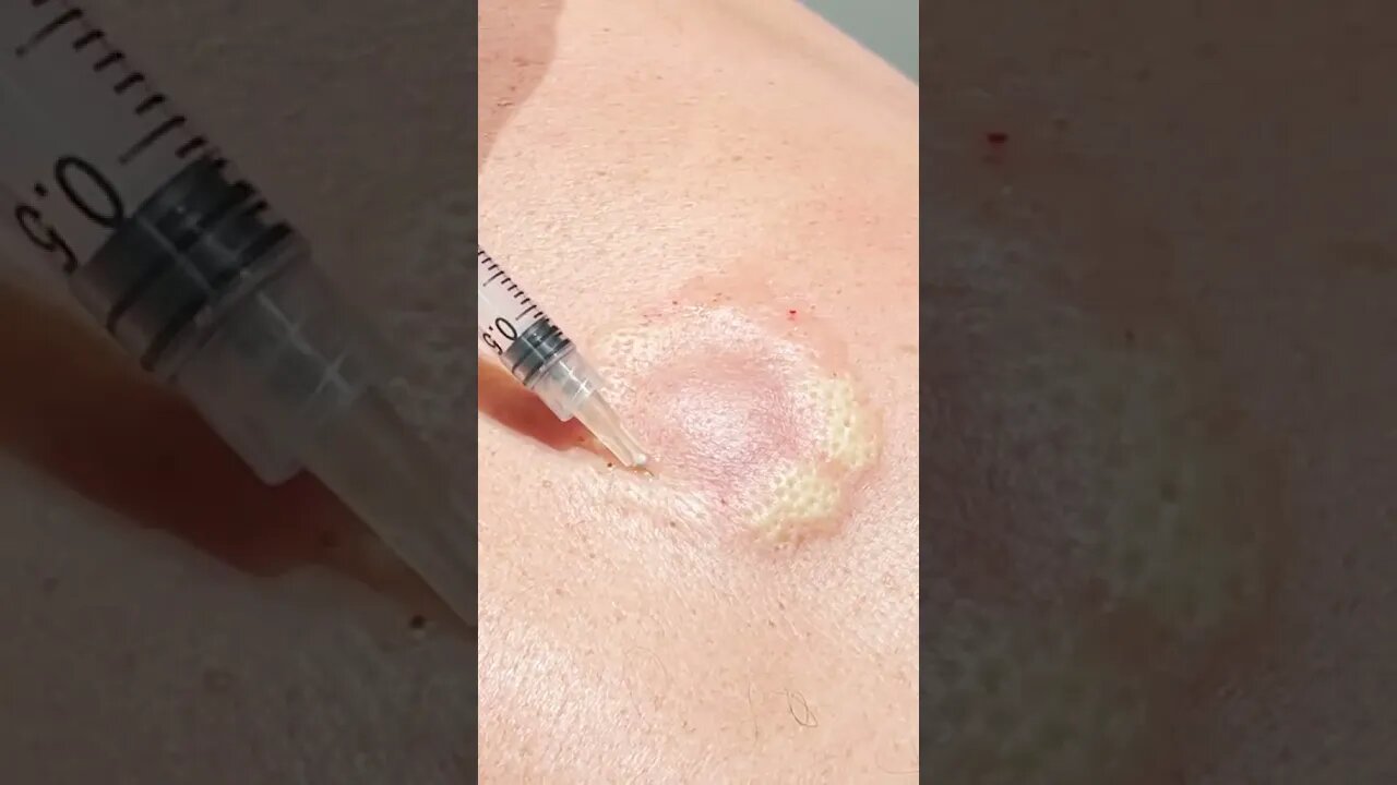 Remoção de Cravos e Espinhas - Remove Squeezing Blackheads and Pimples - Just Relax | Apenas Relaxe