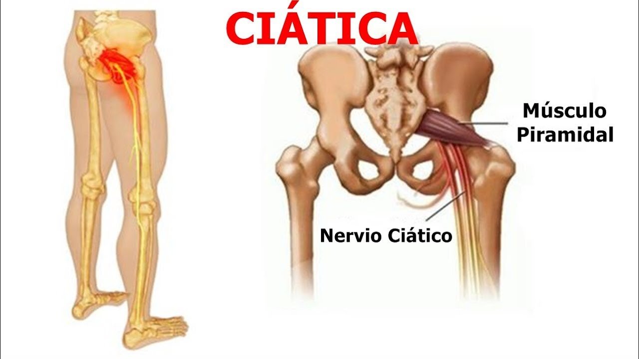 CIATICA NERVIO CIATICO LUMBOCIATICA LAS CAUSAS Y LOS REMEDIOS NATURALES BIODESCODIFICACION