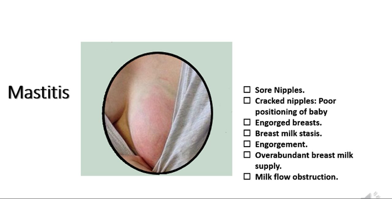 72. Breast Engorgement: Blocked ducts: Mastitis: White spot - nipple