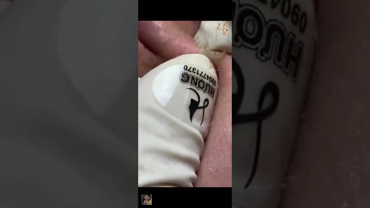 Love these kind of blackheads