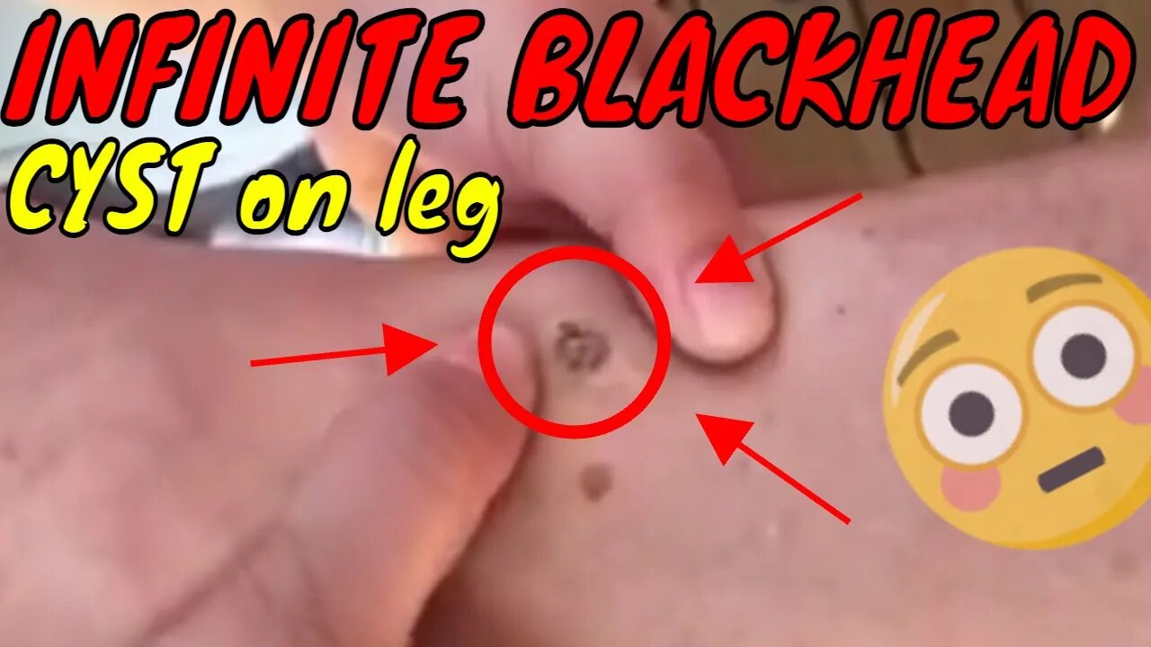 Infinite blackhead cyst on leg 😨 #blackheadremoval #cyst #blackhead #blackheads #satisfying #fyp