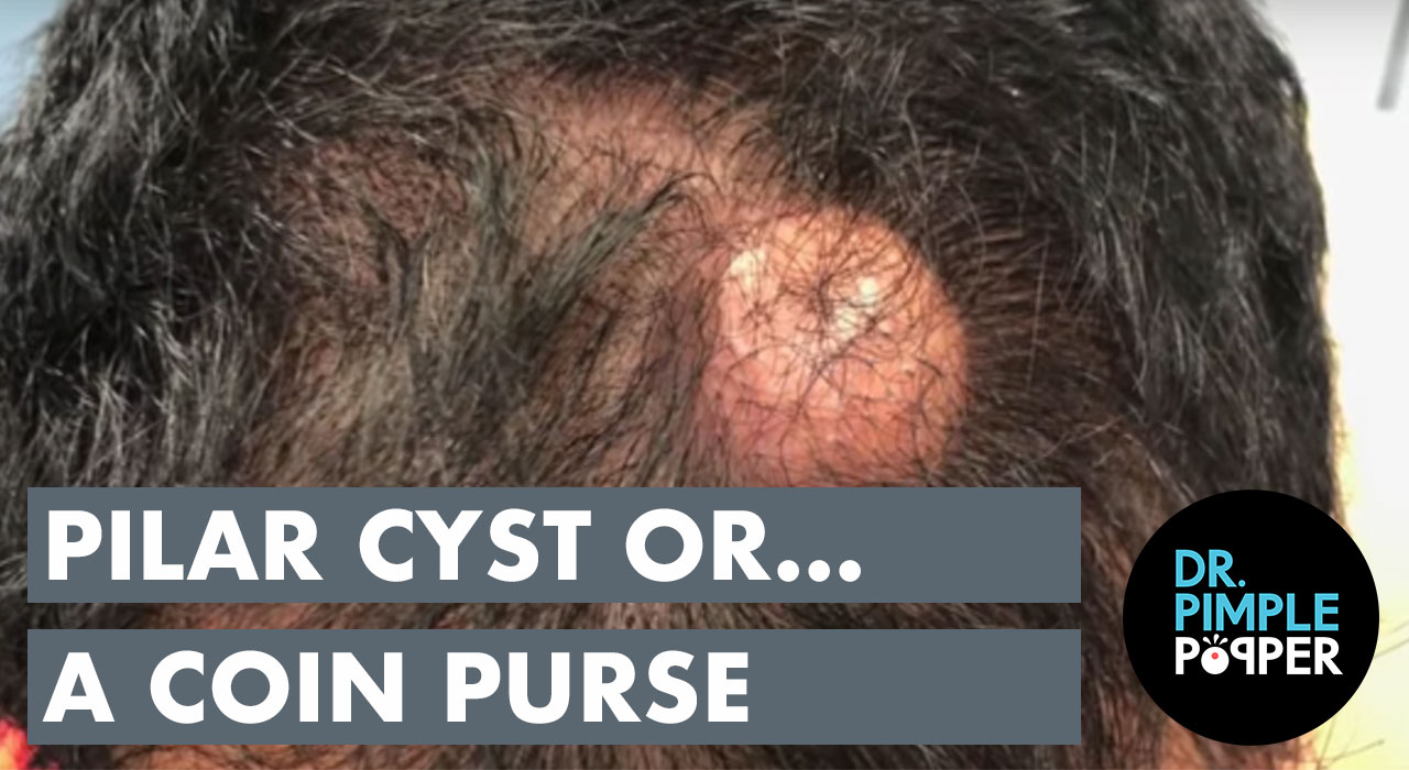 Pilar Cyst like a Coin Purse