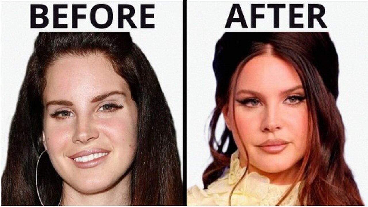 Lana Del Rey's SHOCKING Transformation | Plastic Surgery Analysis