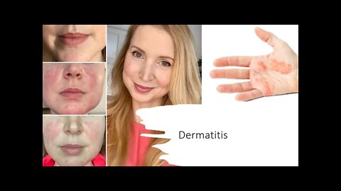 Dermatitis Natural Treatment