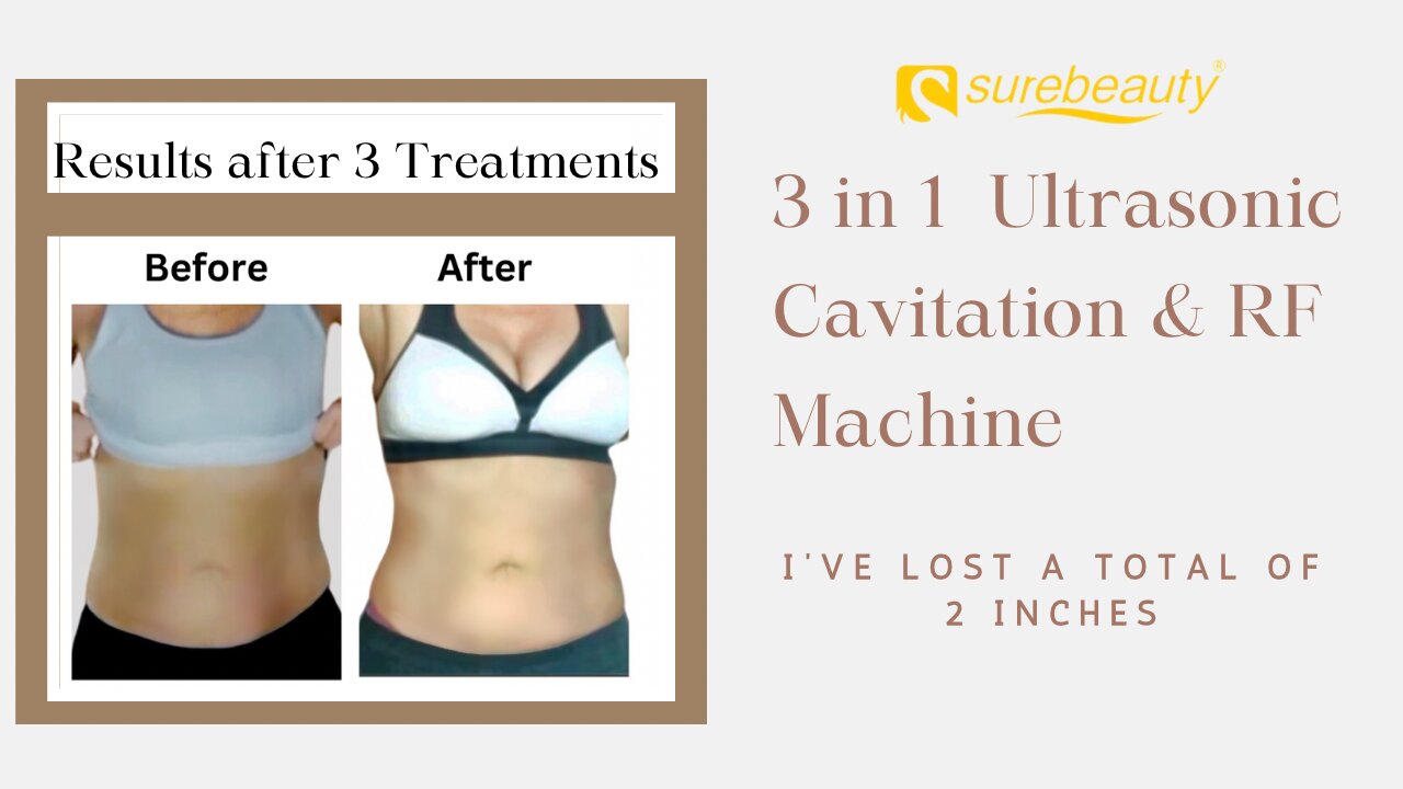 3 in 1 Ultrasonic Cavitation and RF Machine - Before/After