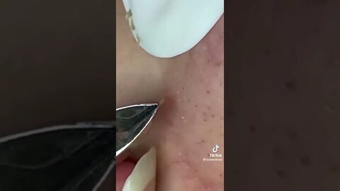 Amazing blackhead removal skills 😅 #blackheadremoval #blackhead #blackheads #blackheadsremoval