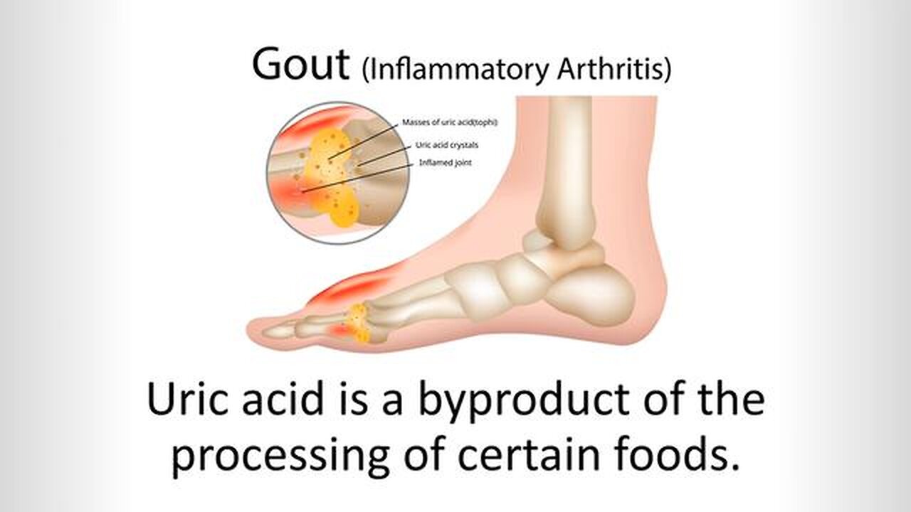 The Road to Gout Recovery: The Comprehensive Solution