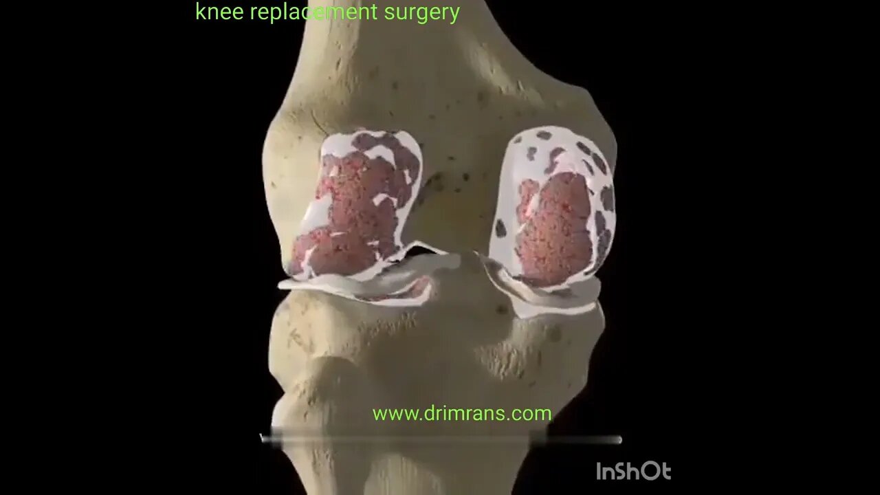 Knee Replacement surgery (3d Animation) Knee transplant