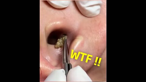 Huge Blackhead removal inside the Ear ! Busy Surgent Tiktok